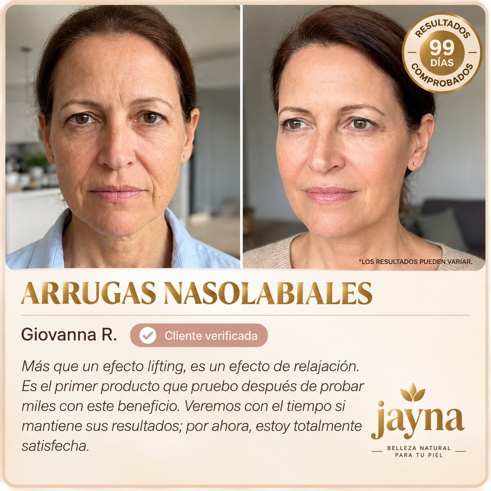 Antes y después, arrugas nasolabiales, Giovanna R.